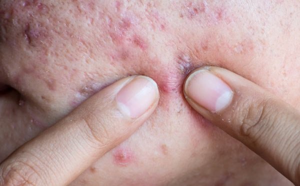 How acne passes and why it occurs, related tips
